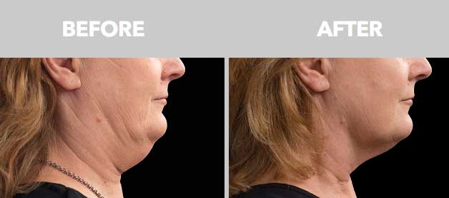 CoolSculpting Before After Double Chin 03