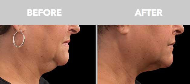 CoolSculpting Before After Double Chin 04