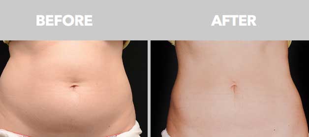 CoolSculpting Before After Images 06