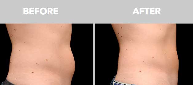 CoolSculpting Before After Abdomen