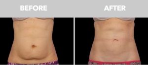 CoolSculpting Before After Images 01