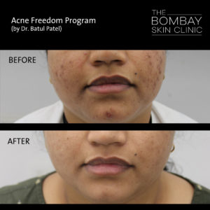 face acne treatment