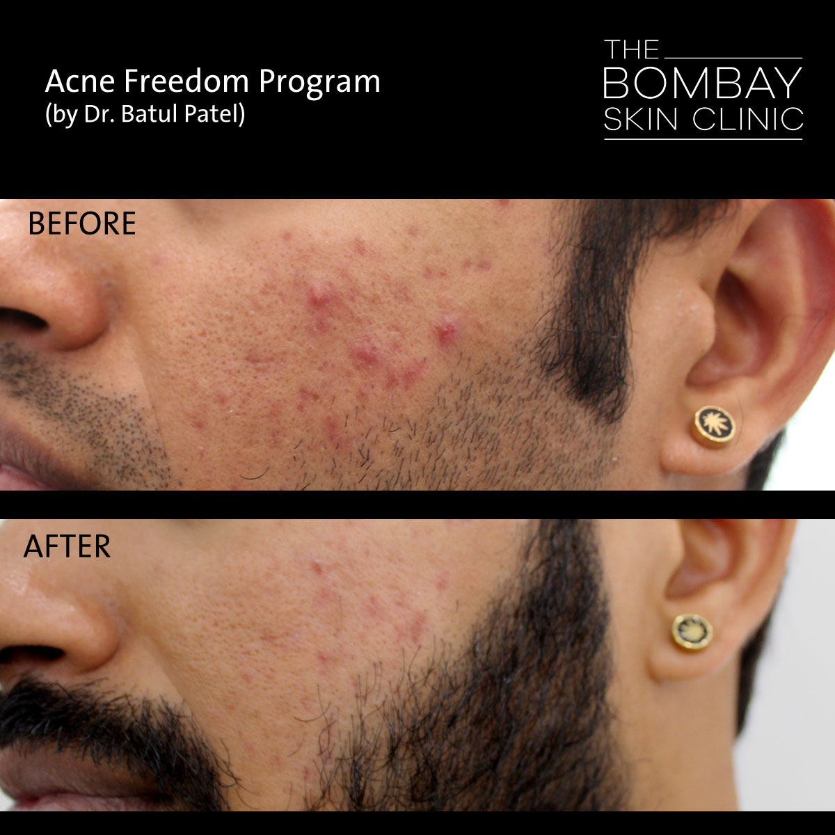 Acne Before After Treatment