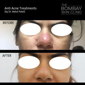 nose acne treatment