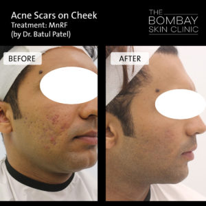 acne scars on cheek treatment