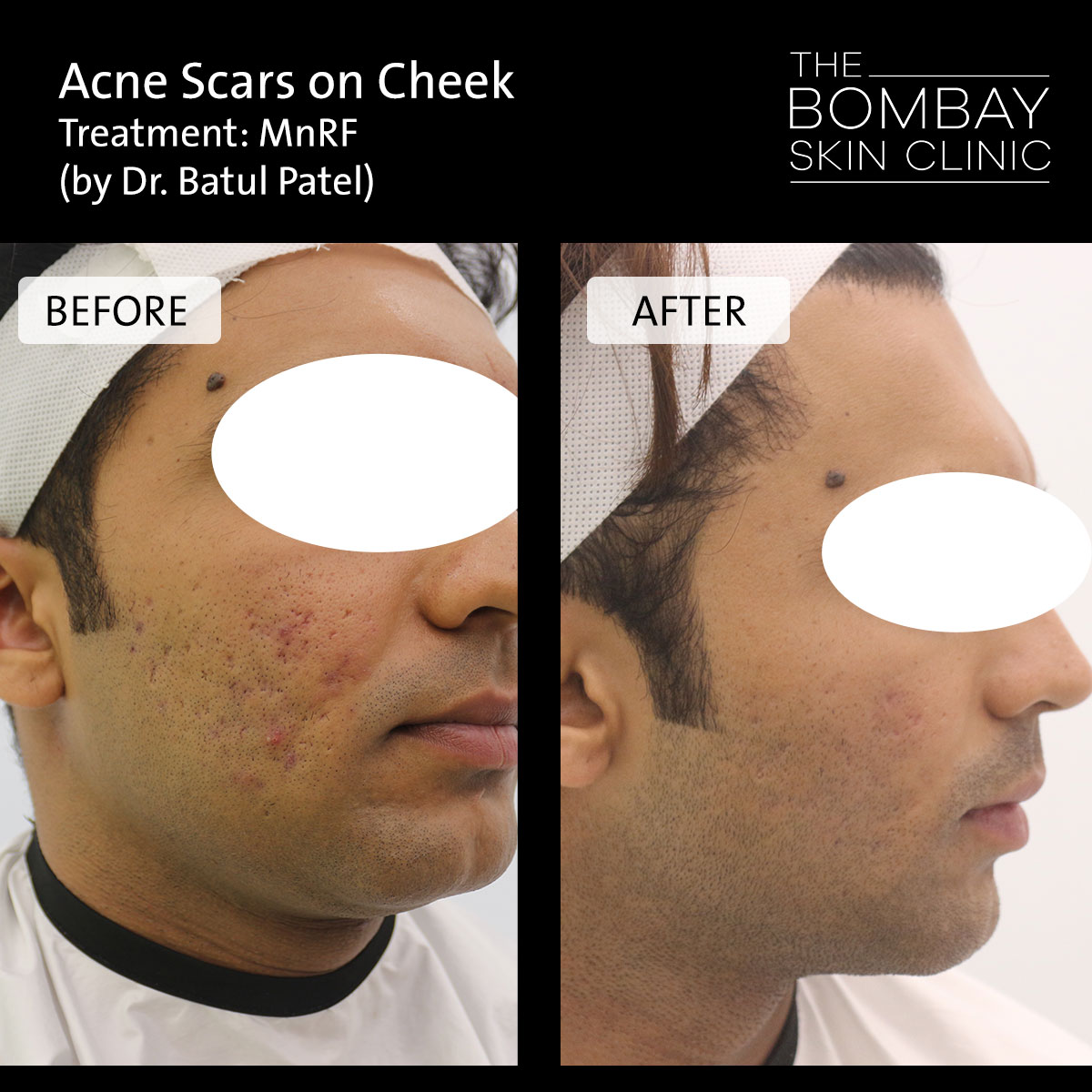acne scars on cheek treatment