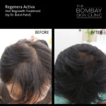 Regenera activa Hair Regrowth treatment