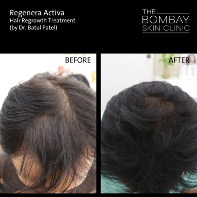 Regenera Activa Treatment for Hair Loss | The Bombay Skin Clinic