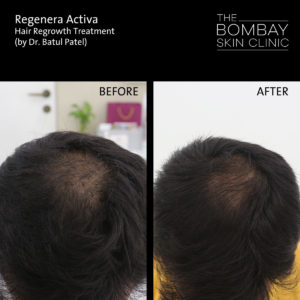 regenera activa hair treatment