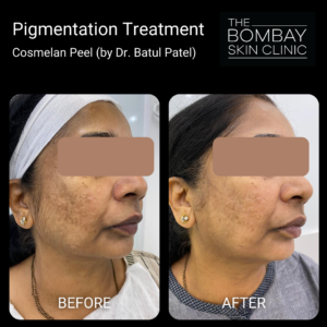 Cosmelan Peel Before After