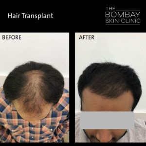 Hair Transplant Mumbai