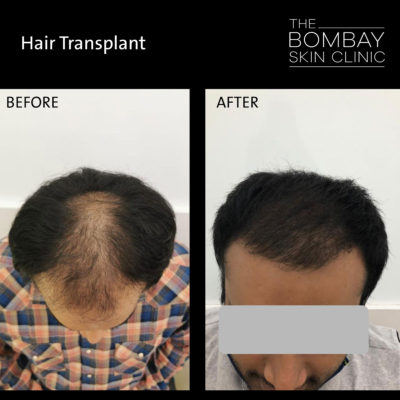 Hair Transplant Treatments in Mumbai - Types, Results & Cost