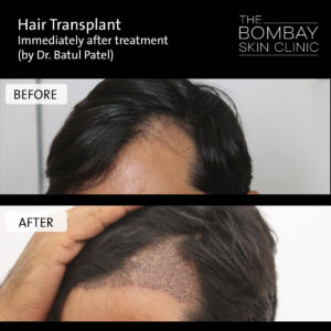 hair transplant treatment