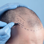 Types of Hair Transplant