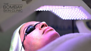 acne treatment light led