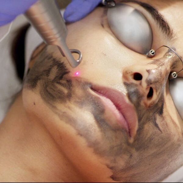laser facial treatment mumbai
