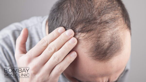 Hair Loss Treatments Men women mumbai