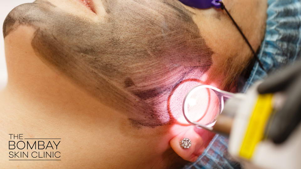 Pirat rabat snigmord Benefits of Laser Facial Treatment - Results & Skin-care Tips