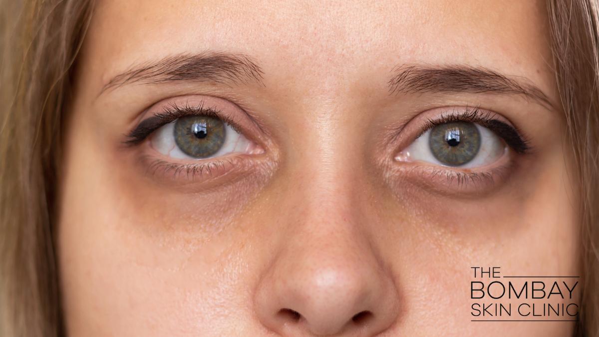 dark-under-eye-circles Dark Circle treatment