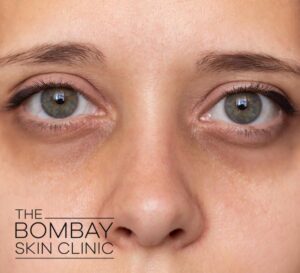 Dark Circles Treatment