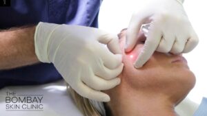 Endolift Laser Treatment