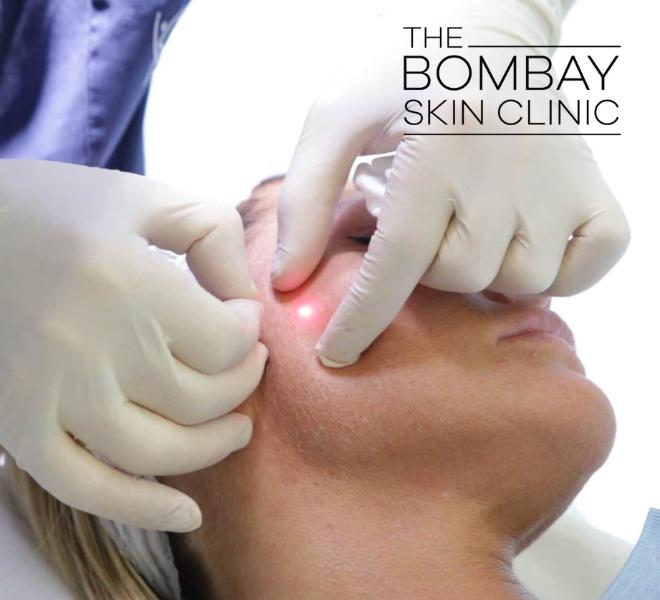 Endolift Laser Treatment