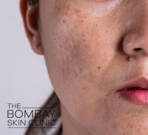 Melasma Treatment
