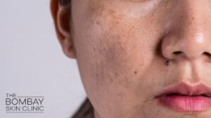 Melasma Treatment