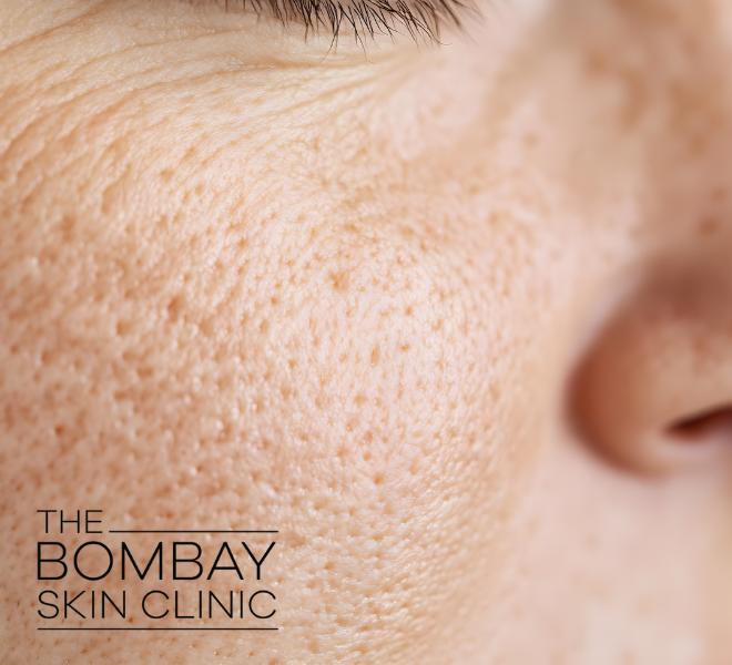 Open Pores Treatment for Oily Skin