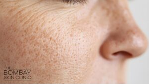 Open Pores Treatment