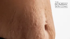 Stretch-Mark-Removal