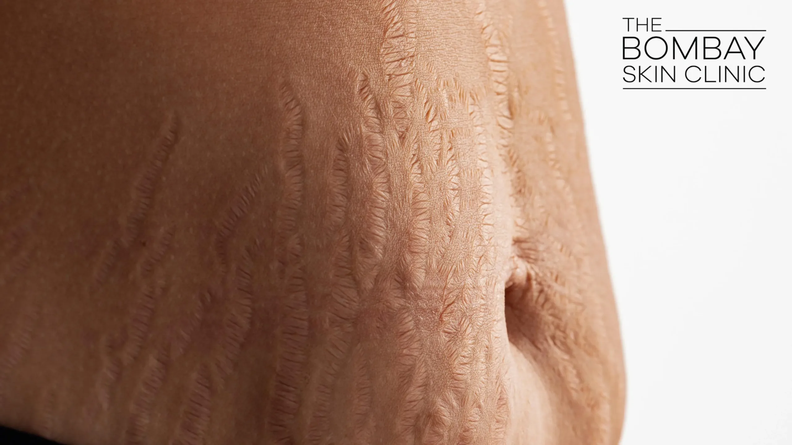 Stretch-Mark-Removal