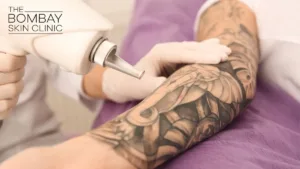 Tattoo-Removal-Mumbai