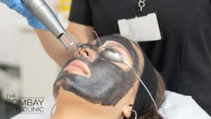 Carbon_Laser_Treatment