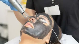 Carbon_Laser_Treatment