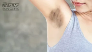 dark-underarms-treatment