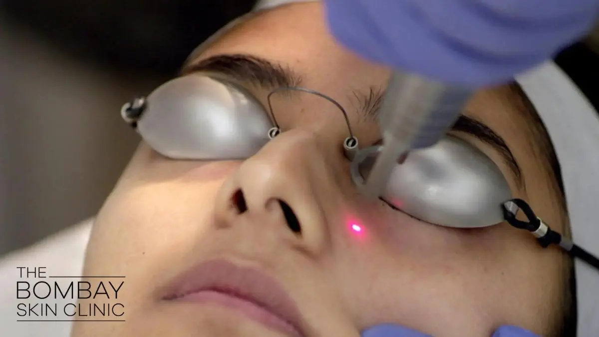 laser-treatment-for-pigmentation