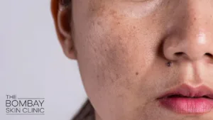melasma-treatment