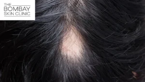 alopecia_areata_treatment