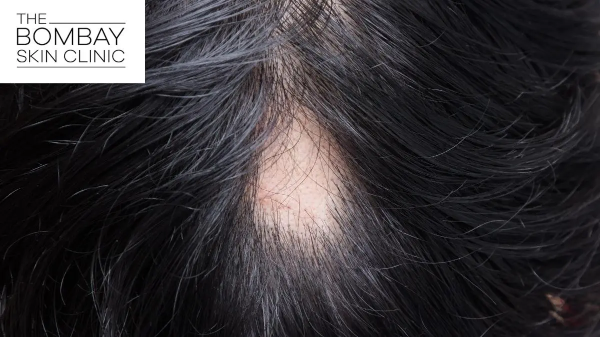 alopecia_areata_treatment