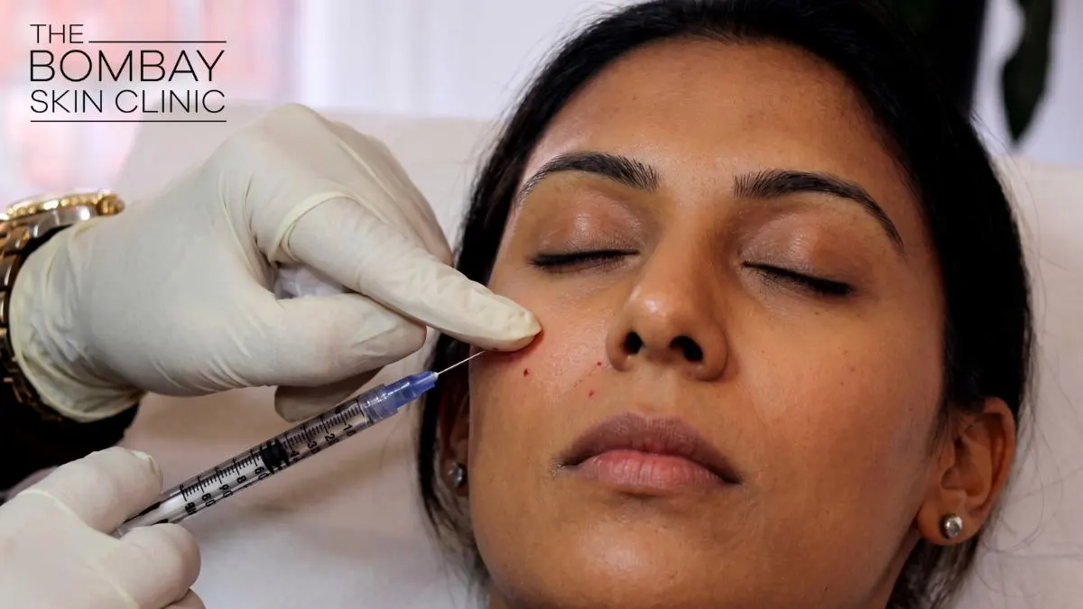 Sculptra_Under-Eye_Filler